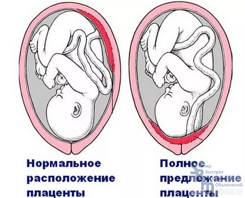 Полное предлежание хориона. Предлежание плаценты. Низкое предлежание плаценты. Аномалии расположения плаценты.