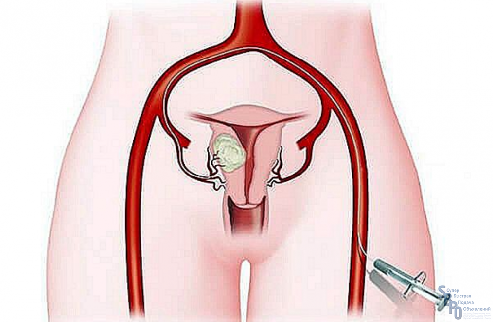 Эмболизация миомы. Эмболизация миомы матки. Эмболизация артерий матки.